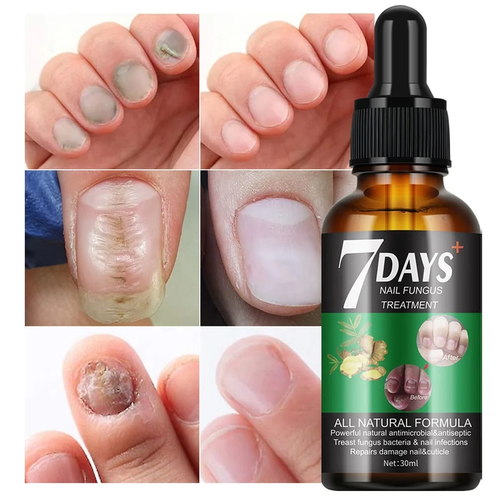 Sérum de traitement contre les mycoses des ongles